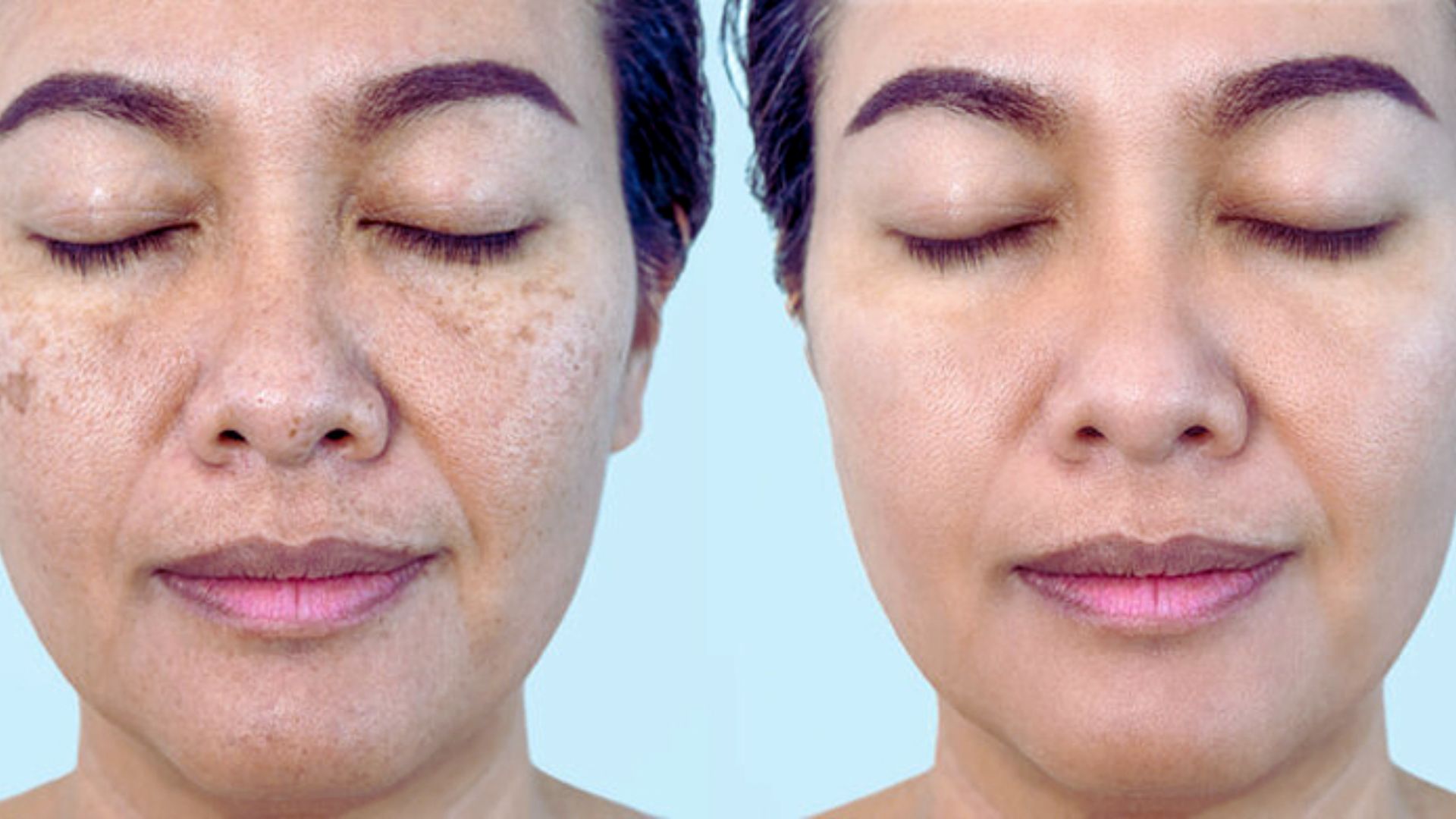 মেলাজমা বা মেছতা কি ? জেনে নিন ডার্মাটোলজিস্টের মতামত !