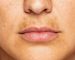 লিপ এরিয়ার পিগমেন্টেশন কনসার্ন—কারা বেশি ভোগেন?