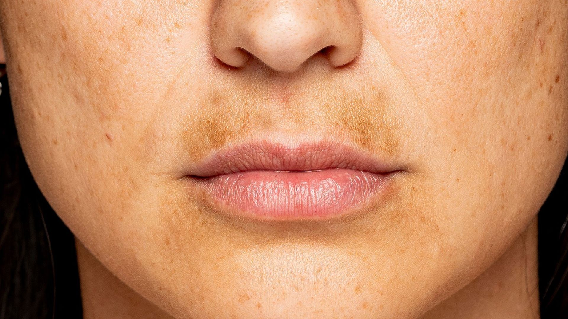 লিপ এরিয়ার পিগমেন্টেশন কনসার্ন—কারা বেশি ভোগেন?